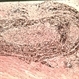 Melanoma with invasion around nerve bundles.